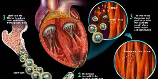 Can Stem Cell Therapies Help With Heart And Cardiovascular Diseases In Malaysia?